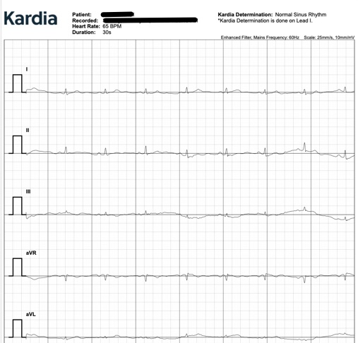 Kardia home EKG ECG monitor strip results